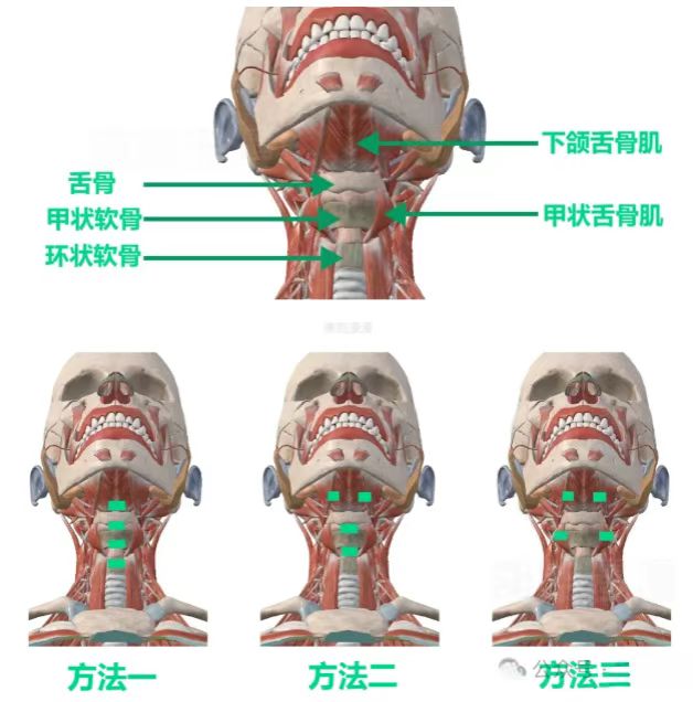 吞咽障碍患者的电极片如何贴放(图2)